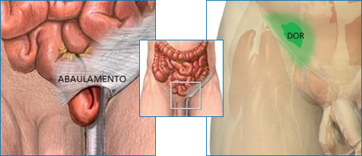 Hérnias podem voltar após a cirurgia?